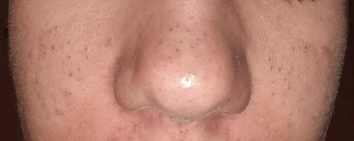 acne comedonica acne comedonica