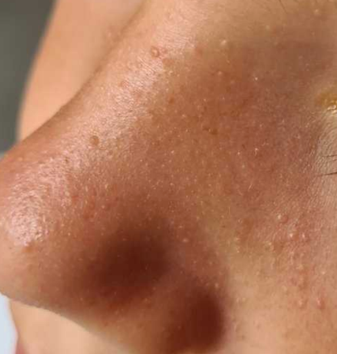 acne comedonica 2 acne comedonica 2