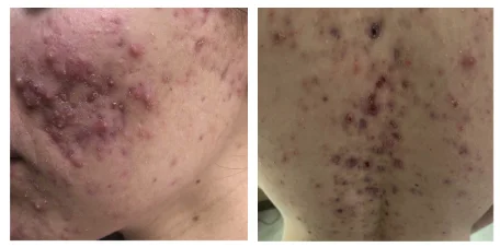 acne conglobata acne conglobata