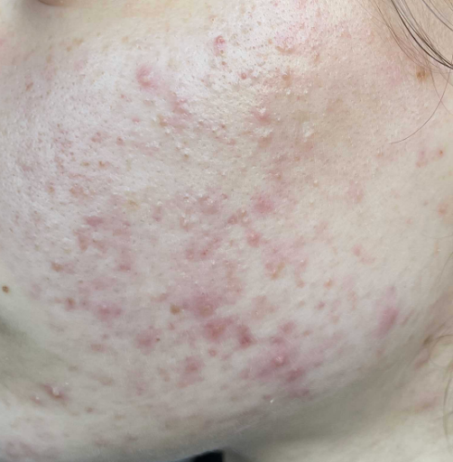 acne cosmetica acne cosmetica