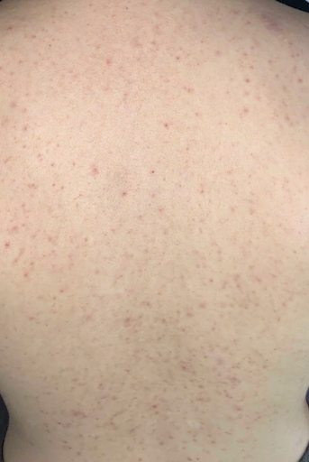 acne medicamentosa acne medicamentosa