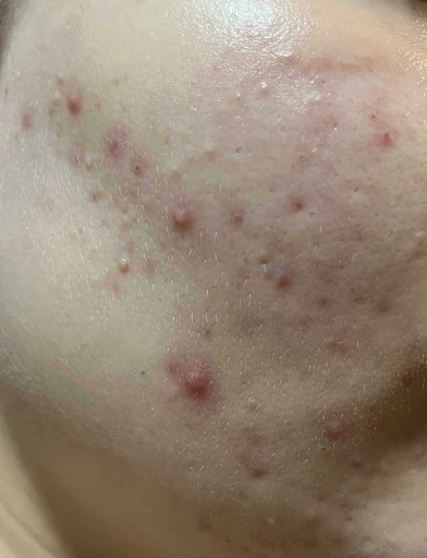 acne papulopustulosa acne papulopustulosa