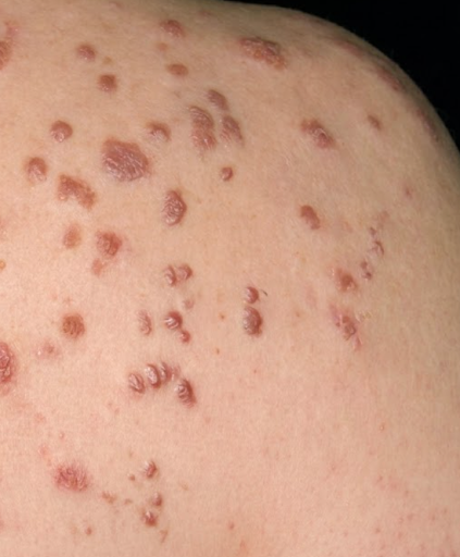 acne keloid acne keloid