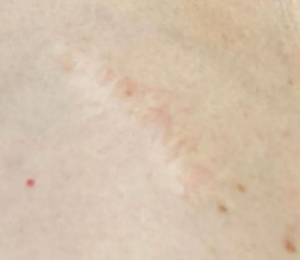 anyajegy eltávolítás heg évtizedekkle később anyajegy eltávolítás heg évtizedekkle később