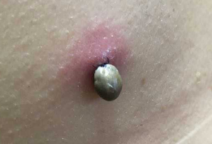 kullancs kullancs