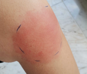 lyme kór lyme kór