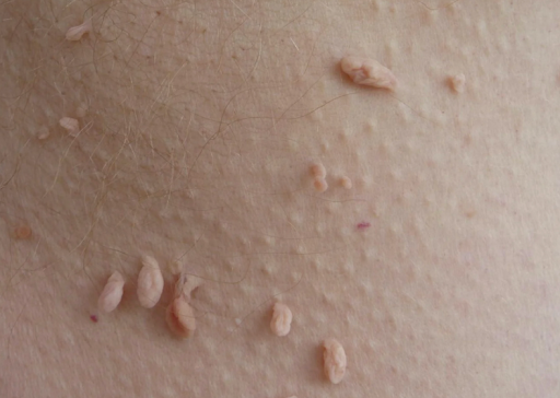 nyeles fibroma nyeles fibroma