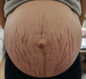 stria korai fazis stria korai fazis
