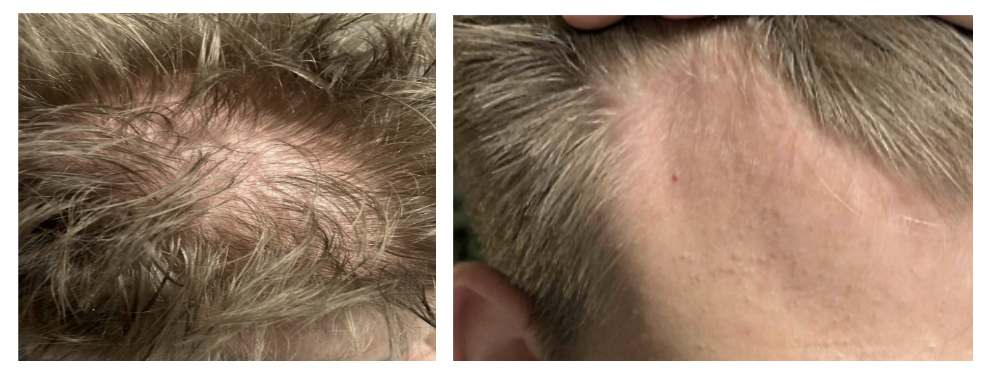 Androgén alopecia Androgén alopecia