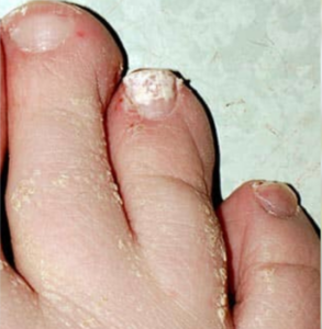 Felületes fehér onychomycosis (körömgomba) Felületes fehér onychomycosis (körömgomba)