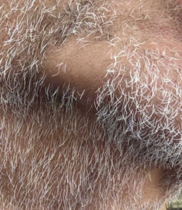 alopecia areata alopecia areata