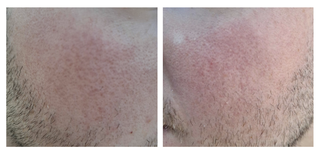 keratosis pilaris keratosis pilaris