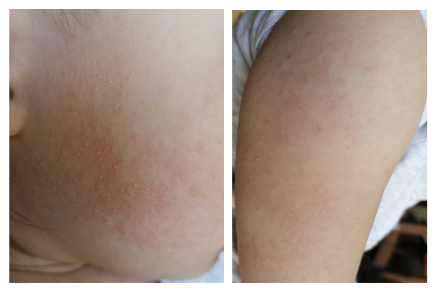 keratosis pilaris gyerek keratosis pilaris gyerek
