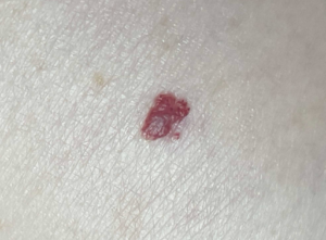 angioma angioma