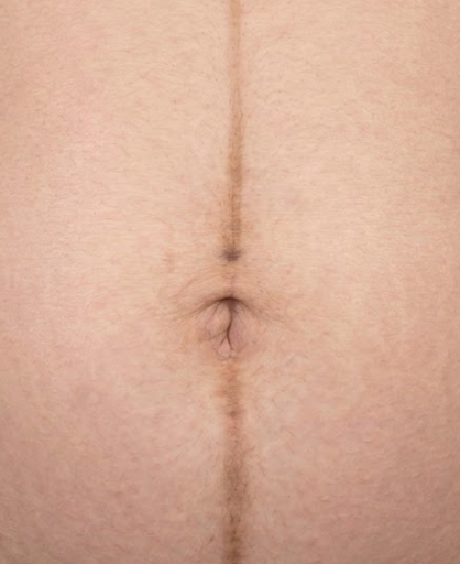 linea nigra